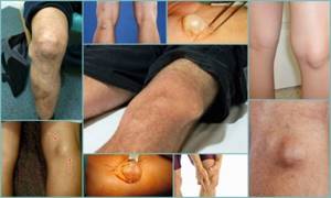 Киста Бейкера коленного сустава: особенности патологии, виды, размеры для проведения операции, подготовка к хирургическому вмешательству, реабилитация
