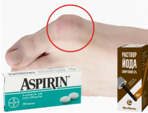 Йод и аспирин от косточек на ногах: компоненты лечебного средства и эффективность, показания и противопоказания к использованию, народные рецепты и инструкция