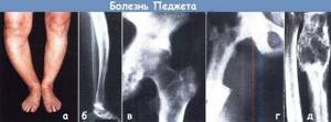 Болезнь Педжета костей: клинические признаки болезни и медикаментозная терапия, ортопедические средства и показания для операции, последствия и прогноз