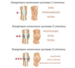 Гемартроз коленного сустава: первая помощь и последующая терапия, симптоматика и причины патологии, диагностика и профилактика недуга