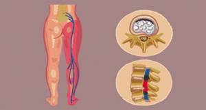 Упражнения при защемлении седалищного нерва и боли в ноге: примеры комплексов, польза и вред ЛФК, как правильно выполнять и длительность тренировок