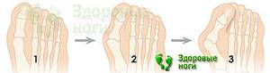 Удаление косточки на большом пальце ноги: причины появления, плюсы и минусы хирургического метода, показания и противопоказания к операции