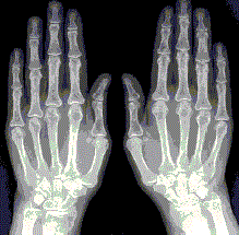 Рентген стадии ревматоидного артрита по признакам и активности: описание патологии и степени активности процесса, виды деформации на снимке