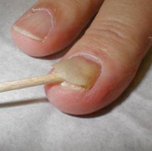 Ушиб ногтя на руке и ноге: что делать, первая помощь, чем лечить народными и аптечными средствами, как минимизировать болевой эффект