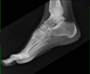 Болят ступни ног: возможные заболевания и методы диагностики болезни, способы избавления от боли и терапевтические мероприятия, профилактика и осложнения