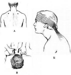 Болит шея сзади: почему возникает боль и как с ней справиться, признаки и возможные патологии, особенности терапии и медикаменты, применение лечебной физкультуры