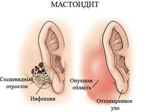 Остит: отчего случается воспаление, виды, симптомы и лечение, профилактика ушных заболеваний