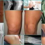 Тендинит коленного сустава: причины и факторы развития болезни, стадии заболевания и его диагностика, консервативные и оперативные методы терапии