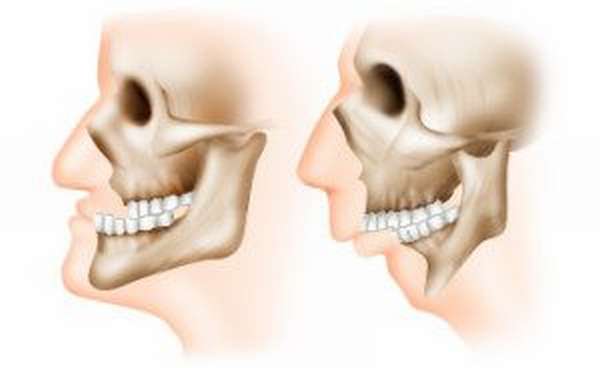 Воспаление челюстного сустава: причины и предрасположенность к заболеванию, специфические симптомы и методы диагностики, способы лечения и возможные осложнения