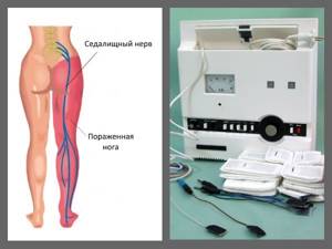 Защемление нерва в ноге: физиотерапевтическое воздействие и особенности терапии, сложности во время беременности и народные методики, применение медикаментов