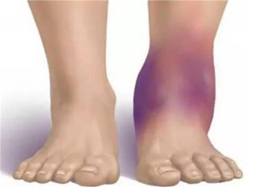 Дисторсия коленного сустава: причины возникновения патологии, механизм ее развития и клинические симптомы, первая помощь и лечебные мероприятия, возможные последствия