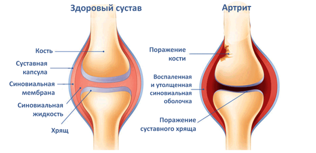 Лечение артрита коленного сустава народными средствами: простые и эффективные рецепты компрессов, ванночек и мазей, польза трав и прием внутрь, противопоказания