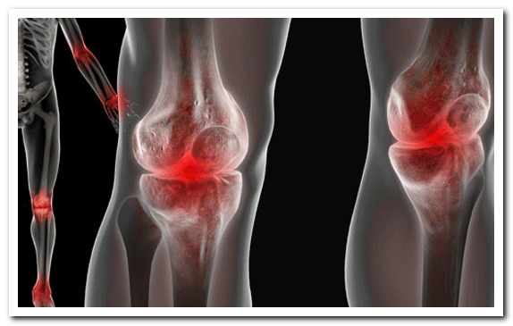 Артроз коленного сустава: признаки возникновения патологии, клиническая картина и способы диагностики, консервативная терапия в домашних условиях и показания для операции