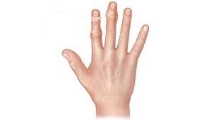 Шишка на большом пальце руки: что это может быть, причины появления, как лечить медикаментозно и показания к удалению