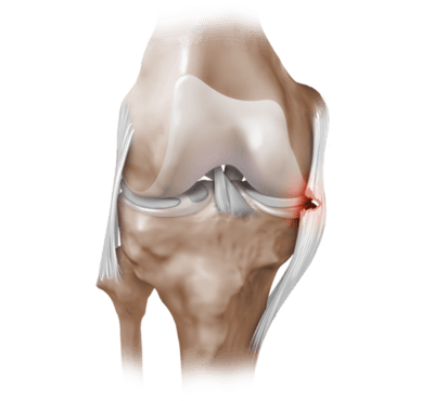 Артроскопия коленного сустава: когда назначается, показания и противопоказания, подготовка и проведение, восстановление после процедуры, рекомендации