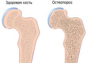 Диагностика остеопороза: причины и симптомы заболевания, виды анализов и исследований для выявления на разных стадиях, способы лечения и меры профилактики в домашних условиях