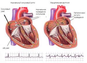 Перебои в сердце при остеохондрозе: причины и механизм формирования дискомфорта, характерные клинические проявления и способы лечения