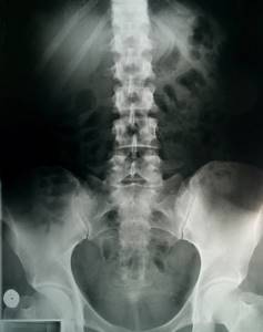 Показывает ли рентген грыжу позвоночника: подготовка к процедуре и методы диагностики, показания и противопоказания к обследованию, расшифровка снимков