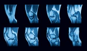 МРТ коленного сустава: показания и противопоказания к проведению диагностики, подготовка и процесс проведения процедуры, информативность и стоимость методики