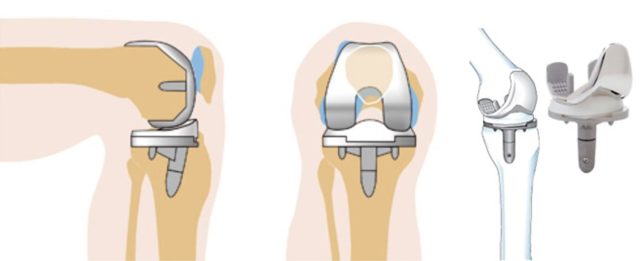 Остеофиты коленного сустава: причины возникновения и симптомы, общие правила и методы лечения, физиотерапевтические процедуры