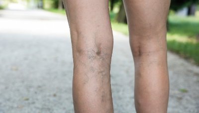 Дисторсия коленного сустава: причины возникновения патологии, механизм ее развития и клинические симптомы, первая помощь и лечебные мероприятия, возможные последствия