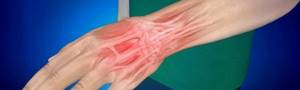 Растяжение кисти руки: понятие и симптоматика патологии, методы терапии и первая помощь, диагностика и реабилитация, клиническая картина болезни