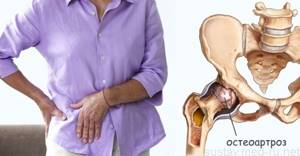 Гимнастика для суставов при остеоартрозе: основные цели ЛФК, эффективные комплексы упражнений и правила их выполнения, противопоказания к лечебной физкультуре