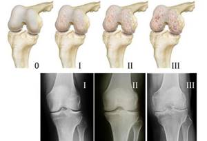 Остеопороз коленного сустава: что это за болезнь, описание и клиническая картина, признаки патологии и методы диагностики, лечебные способы