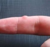 Гигрома пальца руки: причины появления новообразования, характерные симптомы и методы диагностики, современные и народные способы лечения, возможные осложнения и прогноз
