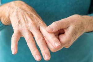 Компрессы для лечения артрита: причины и симптомы заболевания, обзор рецептов народной медицины, правила проведения процедур в домашних условиях