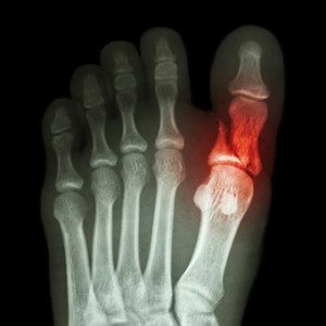 Перелом большого пальца на ноге: классификация повреждения, отличительные признаки и диагностика, лечение и реабилитационные мероприятия, сроки восстановления и осложнения