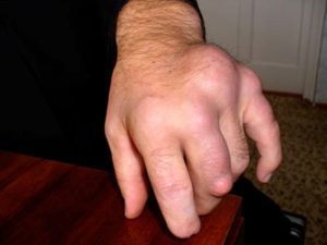 Щелкающий палец (стенозирующий лигаментит): разновидности болезни и причины возникновения патологии, способы терапии и показания к операции