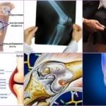 Периартрит коленного сустава: причины и симптоматика, диагностика заболевания и лечебные методы, список таблеток и мазей