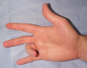 Щелкающий палец: описание патологии и методы лечения народными средствами и медикаментами, чем это опасно
