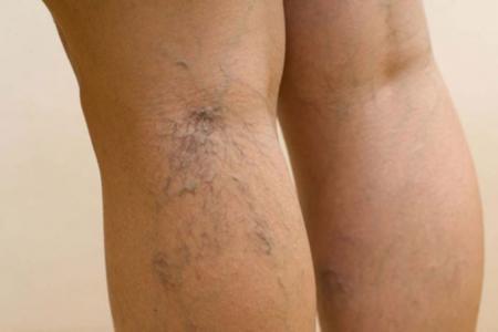 Почему болят икры ног: провоцирующие факторы и патологические причины болей, сопутствующие симптомы, лечение препаратами и народными средствами