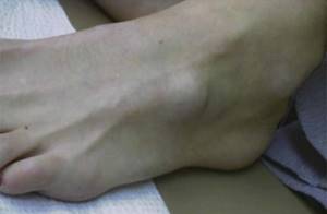 Шишка на ноге сбоку с внешней стороны стопы: что это может быть, возможные заболевания, основные причины и методы лечения, виды деформаций ног у детей и взрослых