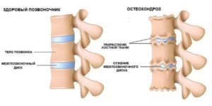 Упражнения с палкой для спины и шеи от остеохондроза: польза и вред физических нагрузок, правила выполнения зарядки, примеры движений и противопоказания