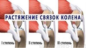 Растяжение связок коленного сустава: как проявляется, симптомы, первая помощь, разрешенные упражнения, диагностика и лечение