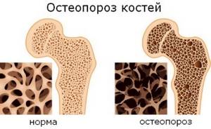 Мумие при остеопорозе: полезные свойства и лечение им заболеваний суставов и костей, правила применения и народные рецепты, возможные противопоказания к использованию