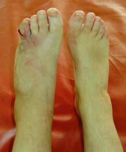 Перелом мизинца на ноге: классификация травмы, отличительные симптомы и методы диагностики, способы лечения и реабилитационный период, возможные осложнения