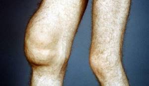 Гипермобильность суставов: описание и особенности патологии, причины развития и специфические симптомы, методы диагностики и лечения, степень распространенности недуга