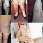 Косточка на ноге: механизм развития и клиническая картина патологии, стадии заболевания и способы терапии, медикаменты и физиотерапия