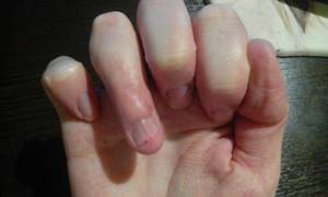 Онемение пальцев рук: терапия народными средствами и медикаментами, упражнения и способы диагностики состояния, возможные заболевания и клиническая картина
