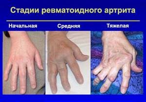 Воспаление суставов кисти руки: провоцирующие факторы, причины и симптомы патологии, методы диагностики, лечение и профилактика средствами народной медицины