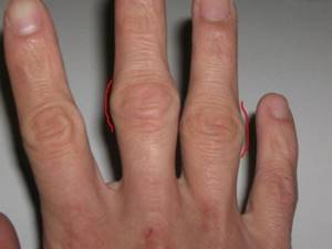 Воспаление суставов пальцев рук: причины, клиническая картина и симптомы патологии, диагностика и лечение на разных стадиях методами традиционной и нетрадиционной медицины