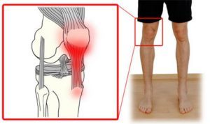 Воспаление связок коленного сустава: причины и характерные симптомы патологии, лечение препаратами и показания к операции, рецепты народной медицины и реабилитация