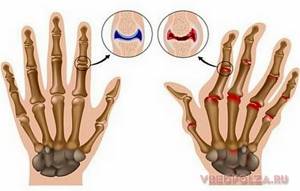 Вреден или нет хруст пальцев: особенности и причины привычки, о чем говорит характерный звук, возможные последствия и методы избавления
