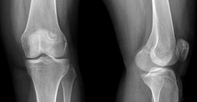 Дисплазия коленного сустава: определение и причины патологии, симптомы, диагностика у детей и взрослых, лечение ортопедическими конструкциями и хирургическим вмешательством