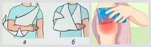 Ушиб плеча: причины травмы, классификация по степени тяжести и основные симптомы, методы диагностики, иммобилизация сустава и способы лечения, возможные осложнения