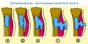 Почему болят ноги от бедра до стопы: причины и признаки заболевания, когда стоит обратиться к врачу, диагностика и лечение